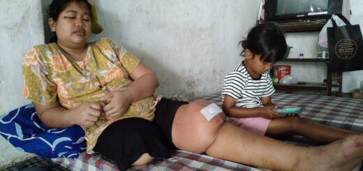 Muniroh, selain kaki kanannya diamputasi karena terkena penyakit kangker, kaki kirinya kini membesar akibat divonis menderita tumor ganas. /Arah Pantura